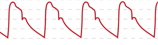 Arterial Waveform (NORMAL)