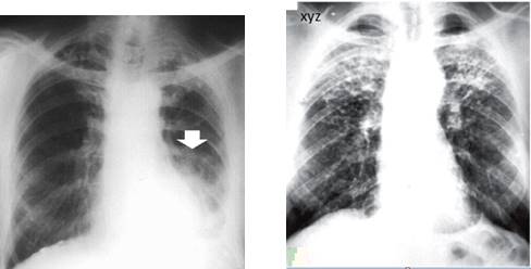 Asbestosis vs silicosis in Chest-xray