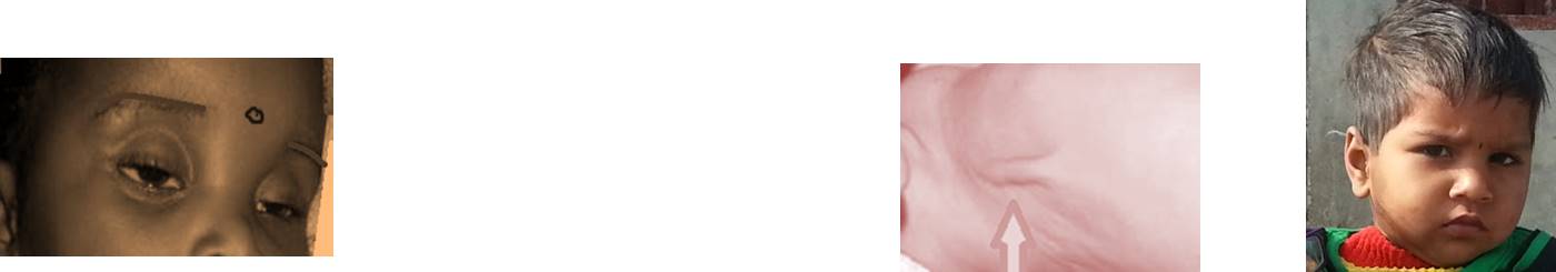 clinical features suggestive of dehydration