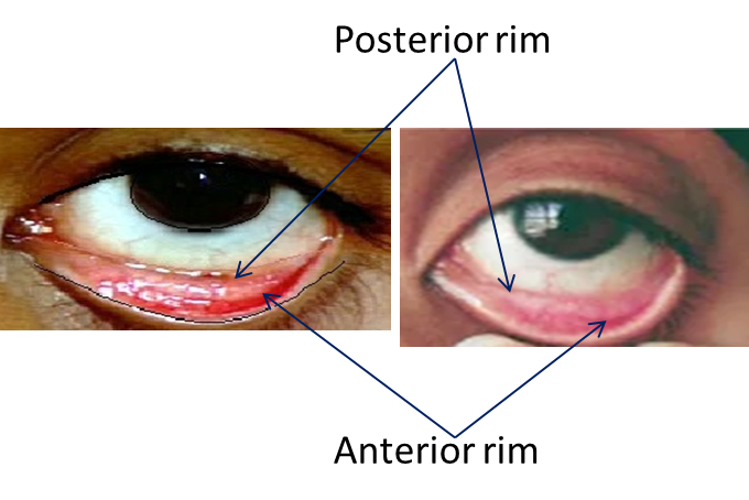 conjuctival rims