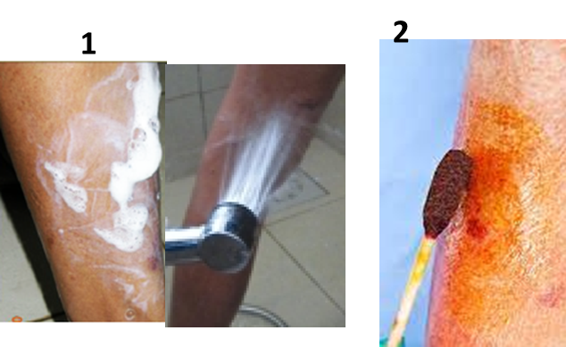 Dog bite washing and iodine application