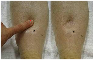 Pitting Edema