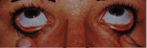 examining for pallor in palpebral conjunctiva