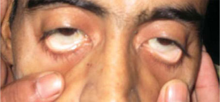 severe pallor conjunctiva