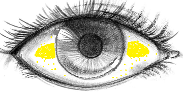 Bitot's Spot formed