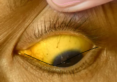 Icterus