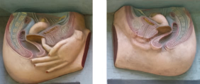 Insertion of diaphragm
