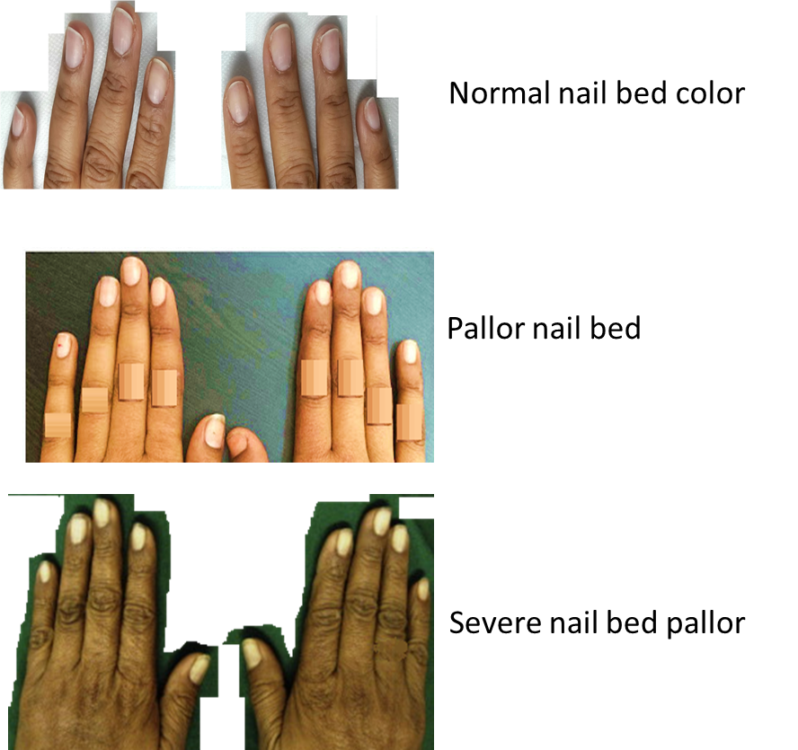 nail bed pallor