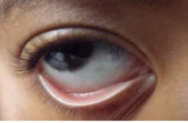 conjunctival pallor