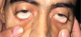 Severe Pallor