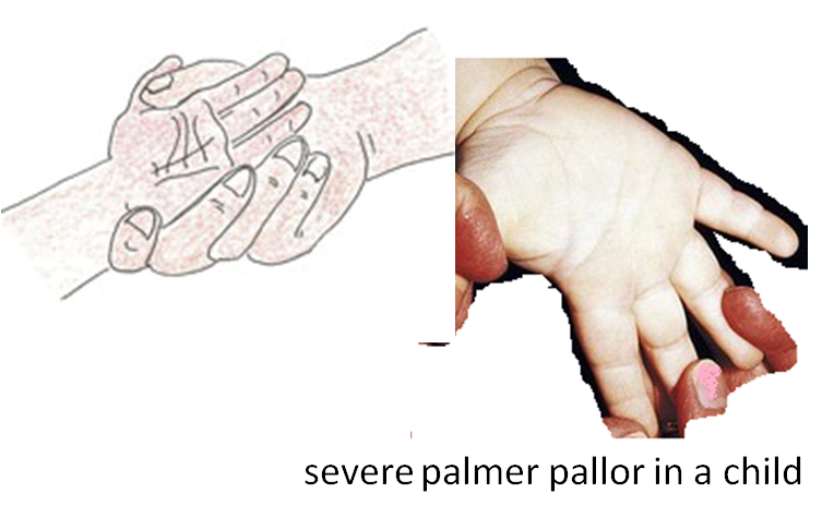 pallor in child imnci