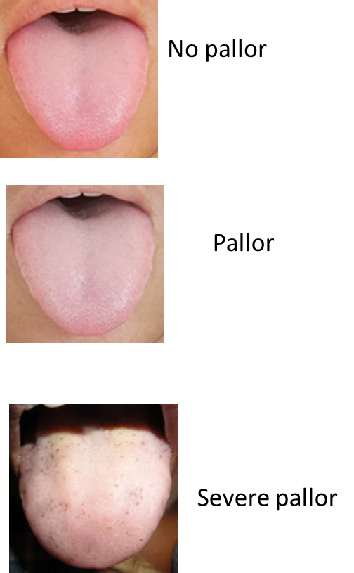 tongue pallor