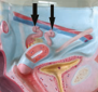Tubectomy model