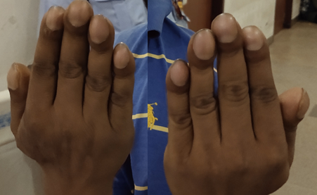 Clubbing in Finger nails