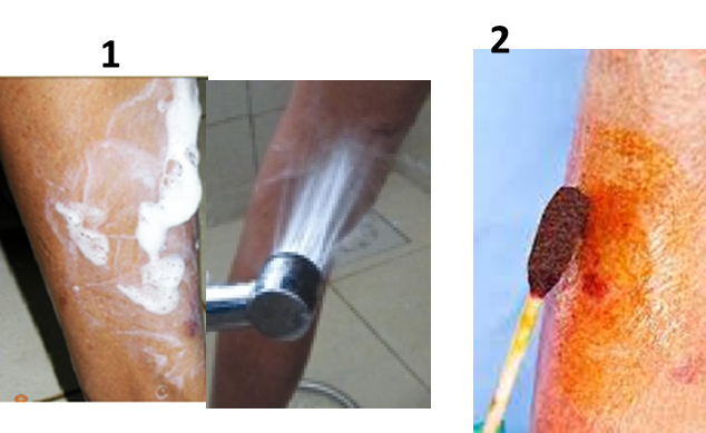 Washing dog bite wound and applying iodine