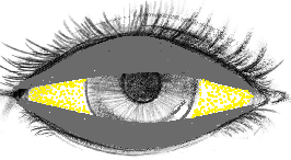 Epithelial debris moves to the center with each blink