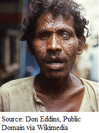 facial scarring and blindness due to smallpox