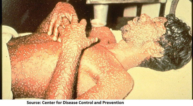A patient of smallpox