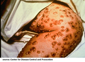 Smallpox lesions 